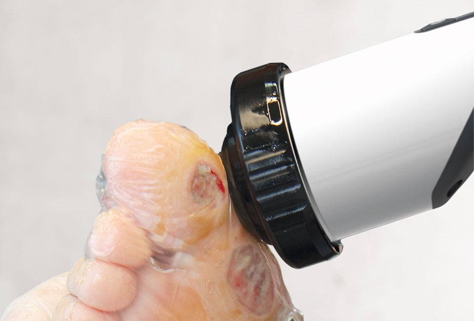 Wound healing