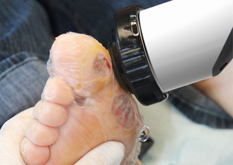 DUOLITH SD1 « ultra » de STORZ MEDICAL approuvé aux États-Unis pour le traitement des plaies de l’ulcère du pied diabétique (UPD)