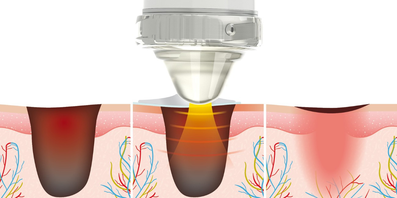 Terapia de ondas de choque en la cicatrizacion