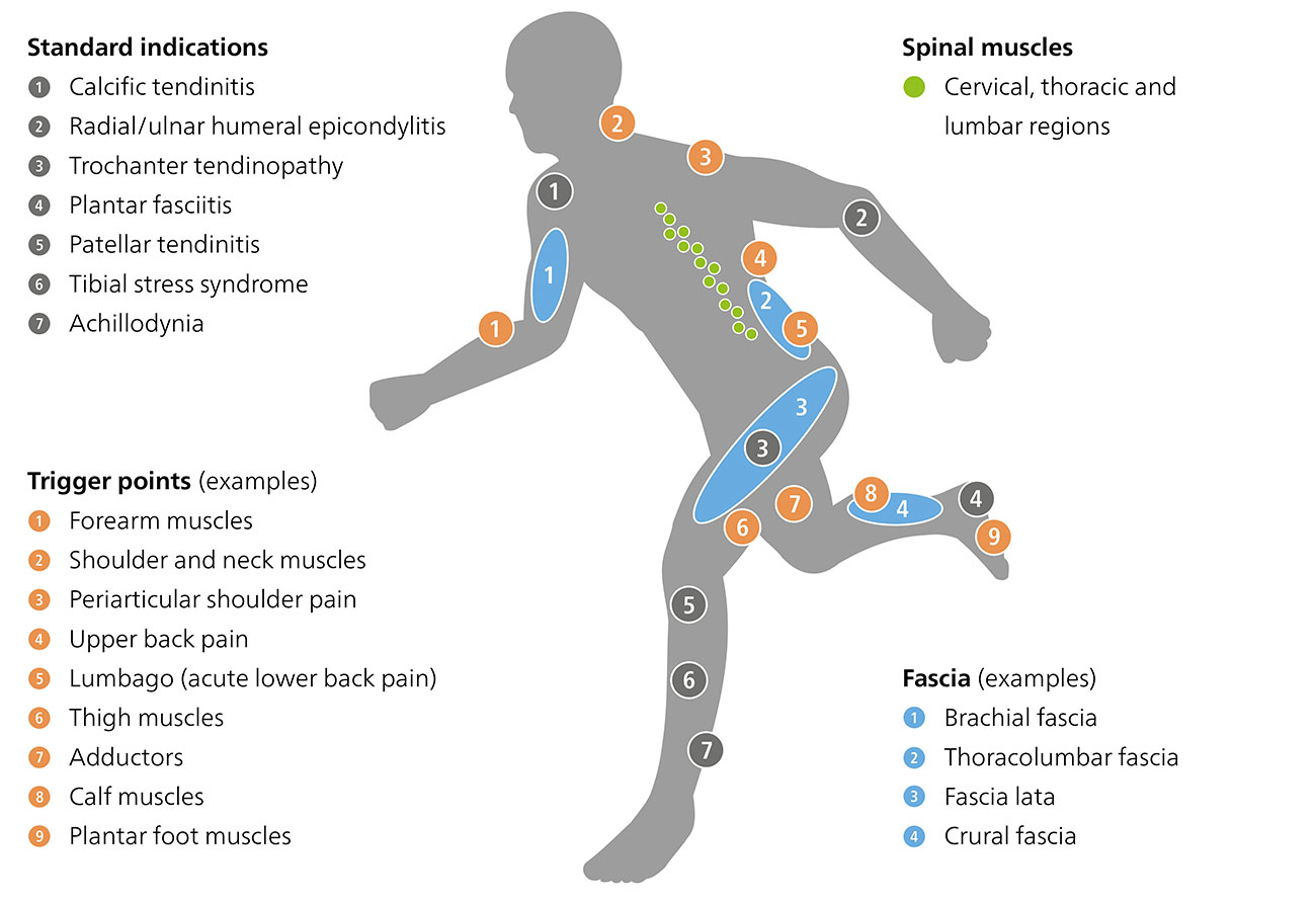 Radial shock wave therapy – Indications