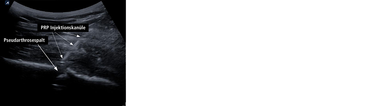 Abb. 2: Platelet-Rich-Plasma-Injektion bei Femurschaftpseudarthrose.